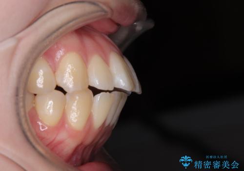 飛び出した前歯を引っ込める　ワイヤー装置での抜歯矯正治療