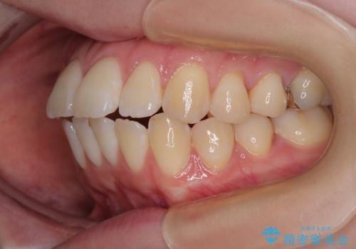 飛び出した前歯を引っ込める ワイヤー装置での抜歯矯正治療の治療前