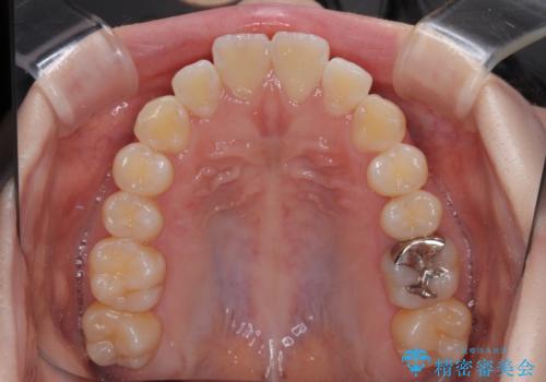 飛び出した前歯を引っ込める　ワイヤー装置での抜歯矯正治療の治療前