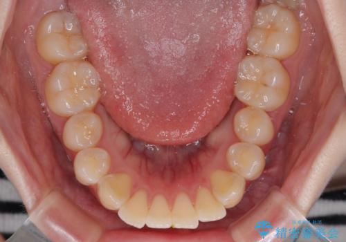 飛び出した前歯を引っ込める ワイヤー装置での抜歯矯正治療の治療前