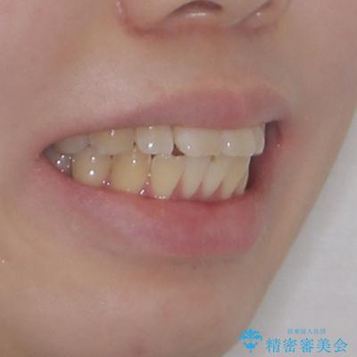 飛び出した前歯を引っ込める ワイヤー装置での抜歯矯正治療の治療前(顔貌)