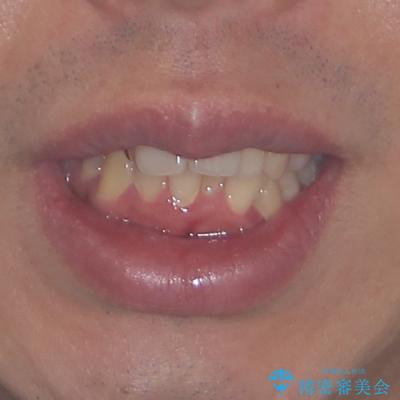 狭くて前方に飛び出した歯列 拡大装置を併用したワイヤー抜歯矯正治療の治療前(顔貌)