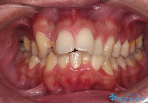 狭くて前方に飛び出した歯列 拡大装置を併用したワイヤー抜歯矯正治療の治療前