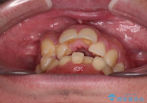 狭くて前方に飛び出した歯列 拡大装置を併用したワイヤー抜歯矯正治療の治療前