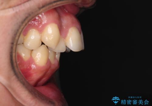 狭くて前方に飛び出した歯列 拡大装置を併用したワイヤー抜歯矯正治療の治療前