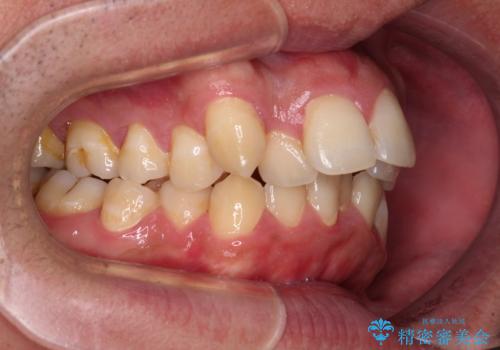 狭くて前方に飛び出した歯列　拡大装置を併用したワイヤー抜歯矯正治療の治療前