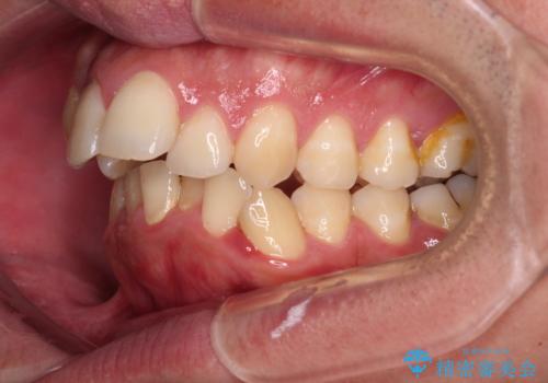 狭くて前方に飛び出した歯列　拡大装置を併用したワイヤー抜歯矯正治療の治療前