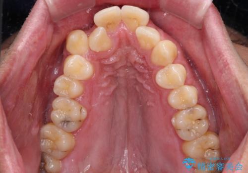 狭くて前方に飛び出した歯列　拡大装置を併用したワイヤー抜歯矯正治療の治療前