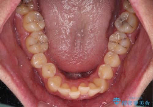 狭くて前方に飛び出した歯列 拡大装置を併用したワイヤー抜歯矯正治療の治療前