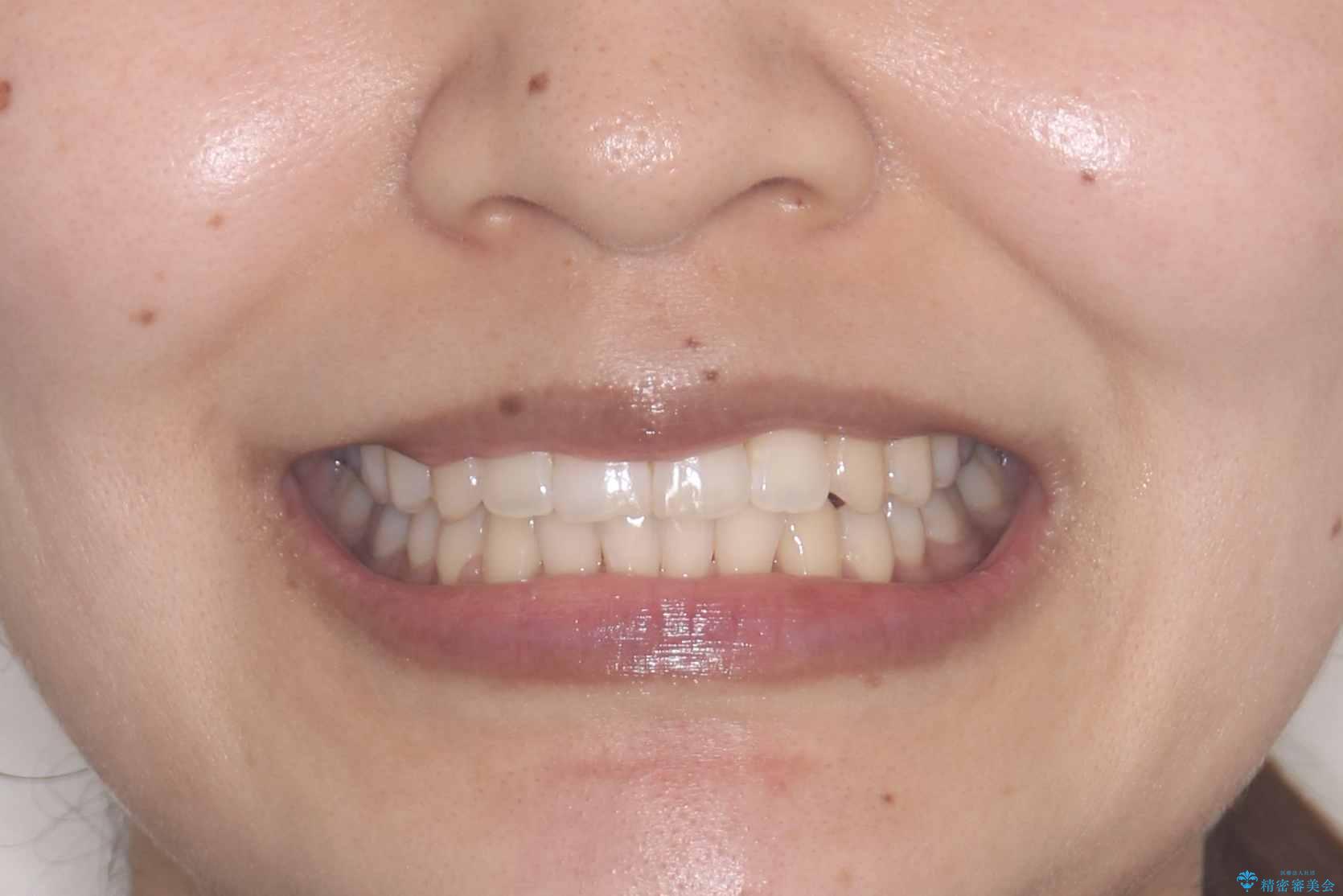 1年でここまで変わる。デコボコ歯並びの非抜歯矯正!の治療後(顔貌)