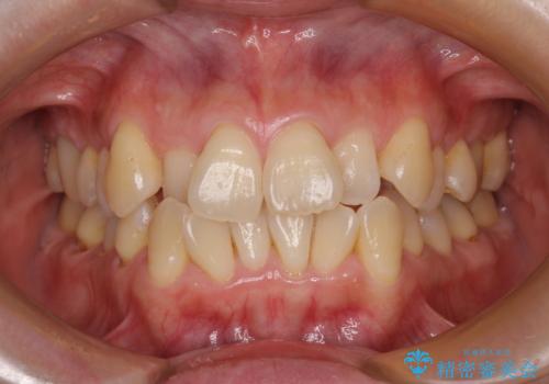 前歯のデコボコをインビザラインで目立たずに改善