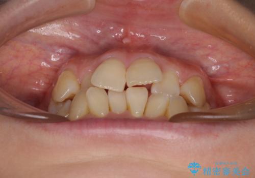前歯のデコボコをインビザラインで目立たずに改善の治療前