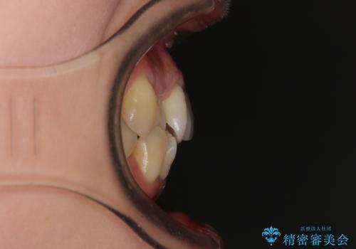 前歯のデコボコをインビザラインで目立たずに改善の治療前