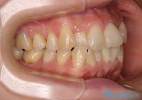 前歯のデコボコをインビザラインで目立たずに改善の治療前