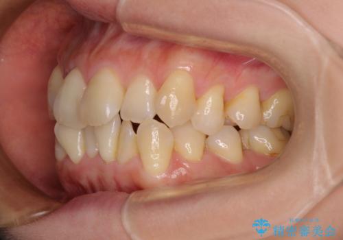 前歯のデコボコをインビザラインで目立たずに改善の治療前