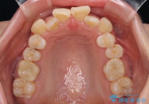 前歯のデコボコをインビザラインで目立たずに改善の治療前