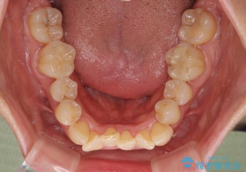 前歯のデコボコをインビザラインで目立たずに改善の治療前