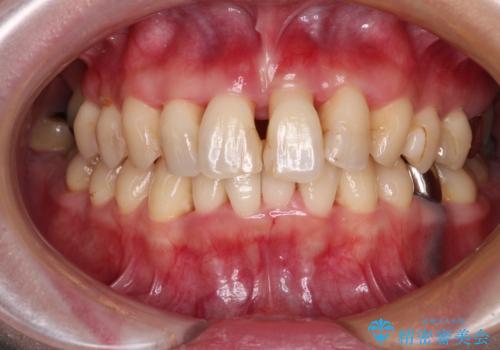 かかりつけ医の治療方針に疑問 歯周病治療と矯正治療を合わせた総合歯科治療の症例 治療前