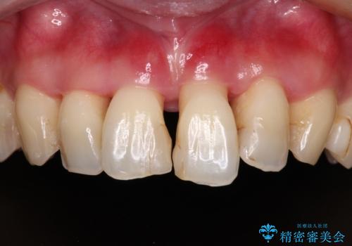 かかりつけ医の治療方針に疑問 歯周病治療と矯正治療を合わせた総合歯科治療の治療前