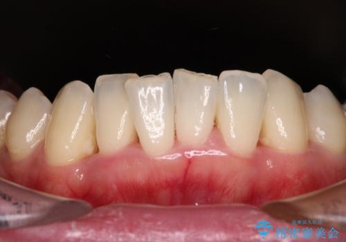 かかりつけ医の治療方針に疑問 歯周病治療と矯正治療を合わせた総合歯科治療の治療前