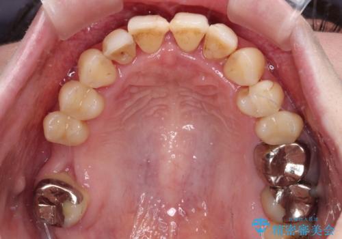 かかりつけ医の治療方針に疑問 歯周病治療と矯正治療を合わせた総合歯科治療の治療前