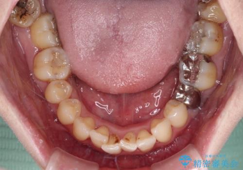 かかりつけ医の治療方針に疑問　歯周病治療と矯正治療を合わせた総合歯科治療の治療前