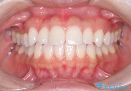 「歯を抜かずに、たった10ヵ月。」目立ちにくい大人の矯正の治療前