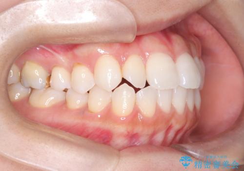 「歯を抜かずに、たった10ヵ月。」目立ちにくい大人の矯正の治療前