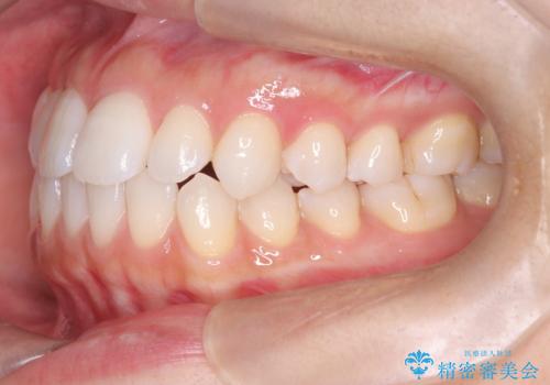 「歯を抜かずに、たった10ヵ月。」目立ちにくい大人の矯正の治療前