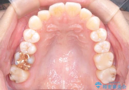 「歯を抜かずに、たった10ヵ月。」目立ちにくい大人の矯正の治療前