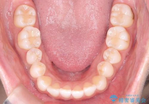 「歯を抜かずに、たった10ヵ月。」目立ちにくい大人の矯正の治療前