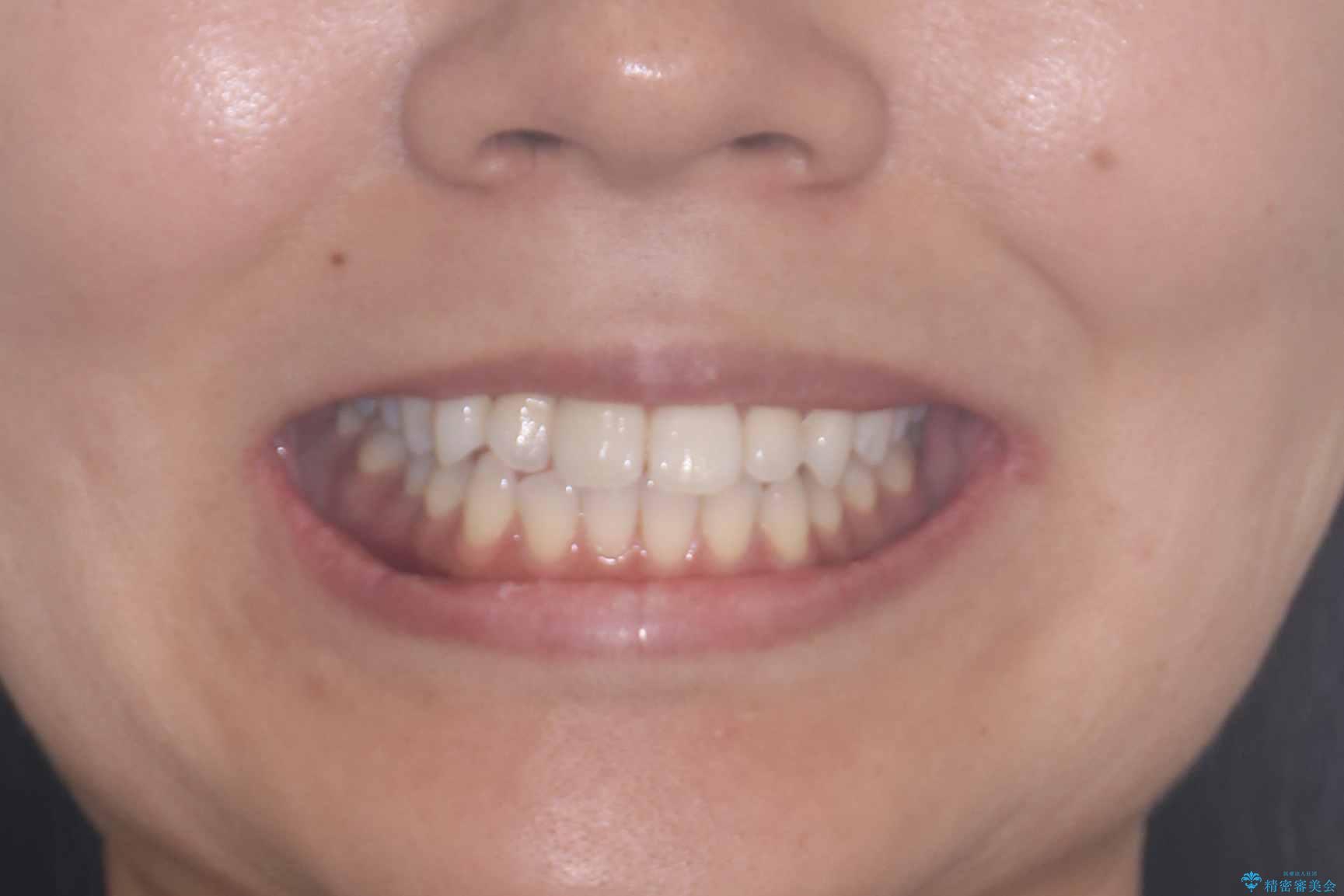 「歯を抜かずに、たった10ヵ月。」目立ちにくい大人の矯正の治療前(顔貌)