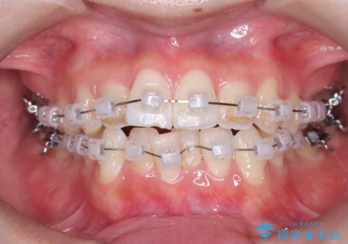 1年でここまで変わる。デコボコ歯並びの非抜歯矯正!の治療中