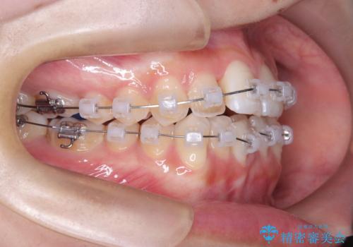 1年でここまで変わる。デコボコ歯並びの非抜歯矯正!の治療中