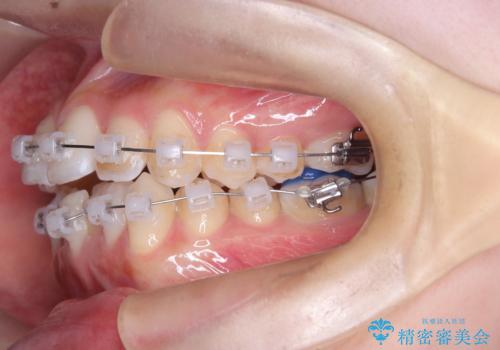 1年でここまで変わる。デコボコ歯並びの非抜歯矯正!の治療中