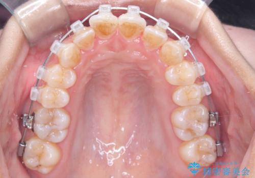 1年でここまで変わる。デコボコ歯並びの非抜歯矯正!の治療中