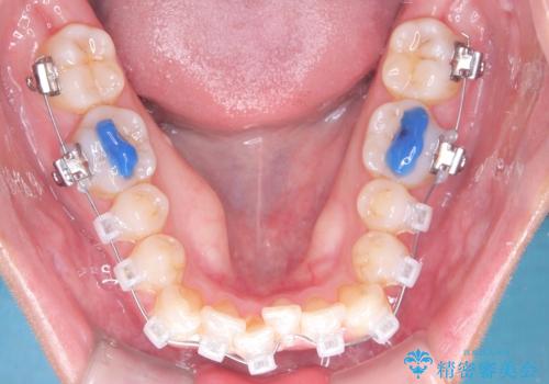 1年でここまで変わる。デコボコ歯並びの非抜歯矯正!の治療中