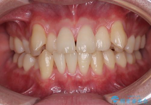 八重歯と重なった前歯　目立たない装置での抜歯矯正