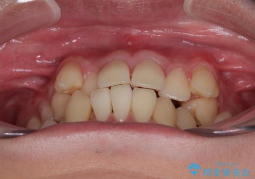 八重歯と重なった前歯　目立たない装置での抜歯矯正の治療前