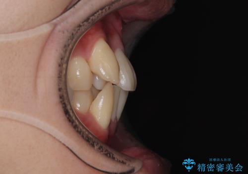 八重歯と重なった前歯　目立たない装置での抜歯矯正の治療前