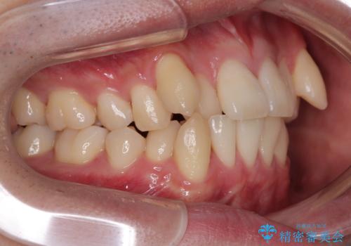 八重歯と重なった前歯　目立たない装置での抜歯矯正の治療前