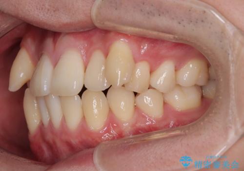 八重歯と重なった前歯　目立たない装置での抜歯矯正の治療前