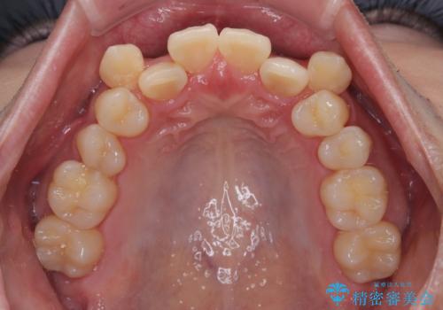 八重歯と重なった前歯　目立たない装置での抜歯矯正の治療前
