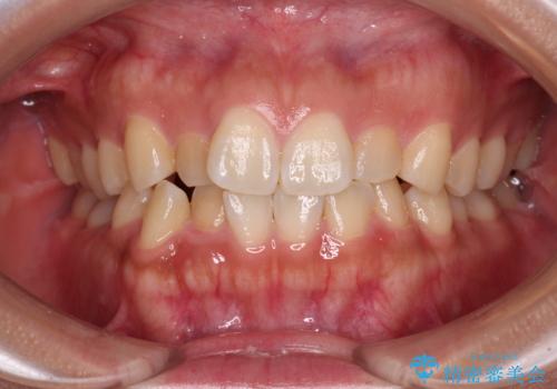 デコボコと捻れて前に飛び出した歯列　抜歯矯正でスッキリした口元に