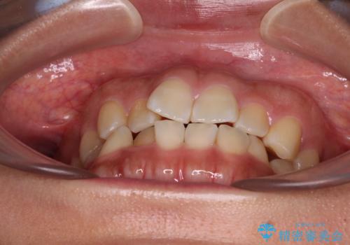 デコボコと捻れて前に飛び出した歯列 抜歯矯正でスッキリした口元にの治療前