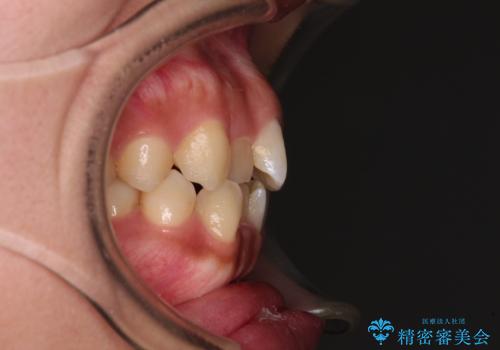 デコボコと捻れて前に飛び出した歯列　抜歯矯正でスッキリした口元にの治療前