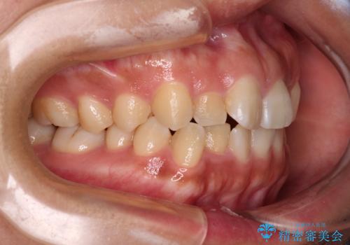 デコボコと捻れて前に飛び出した歯列　抜歯矯正でスッキリした口元にの治療前