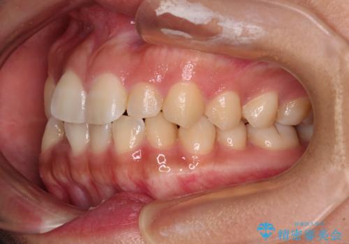 デコボコと捻れて前に飛び出した歯列 抜歯矯正でスッキリした口元にの治療前