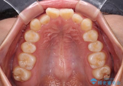 デコボコと捻れて前に飛び出した歯列　抜歯矯正でスッキリした口元にの治療前