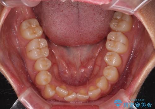 デコボコと捻れて前に飛び出した歯列 抜歯矯正でスッキリした口元にの治療前